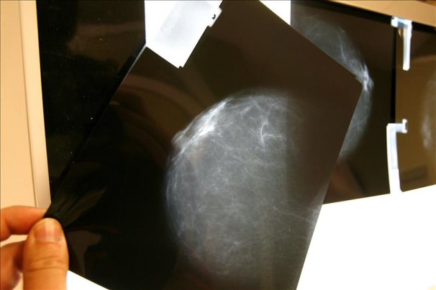 Imagen de archivo de una radiografía de una paciente con cáncer de mama. EFE/Archivo