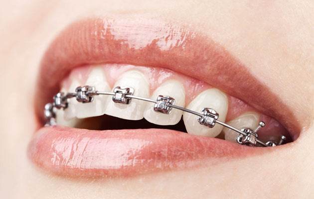 Braces Price