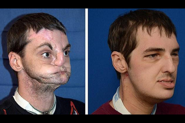 زرع وجه بدون فكين وشفتين وأنف وأسنان شاهد الصور  Face-transplant-181012-630-03-jpg_074748