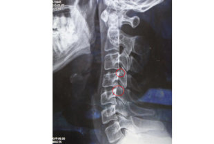 低頭族長期姿勢不正確，從患者X光上可以看出，頸椎受力4、5、6節的部份，已經慢慢增生骨刺。（圖片提供／聖馬爾定醫院）