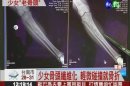 15歲女罹罕病 骨頭太脆一碰就斷