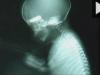 Εικόνα-σοκ: Έμβρυο με σφαίρα στο κρανίο από ελεύθερο σκοπευτή στη Συρία