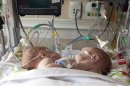This undated photo provided by Medical City Children's Hospital in Dallas shows conjoined boys Emmett, left and Owen Ezell. Hospital officials say the conjoined boys born last month in Dallas have been safely separated and are doing well. (AP Photo/Medical City Children's Hospital)