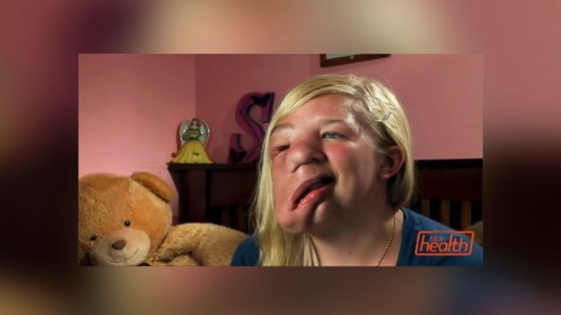 Teen With Half a Face Stands Up to Her Bullies (ABC News)