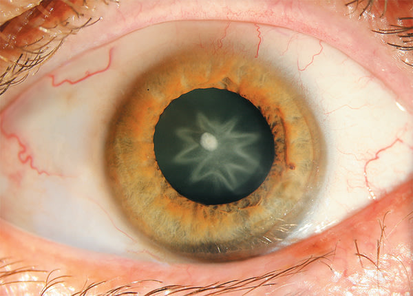 Punch Leaves Man With Star-Shaped Cataract