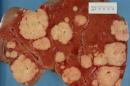 The Hallmarks of Cancer 6: Tissue Invasion and Metastasis
