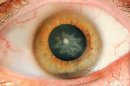 Punch Leaves Man With Star-Shaped Cataract