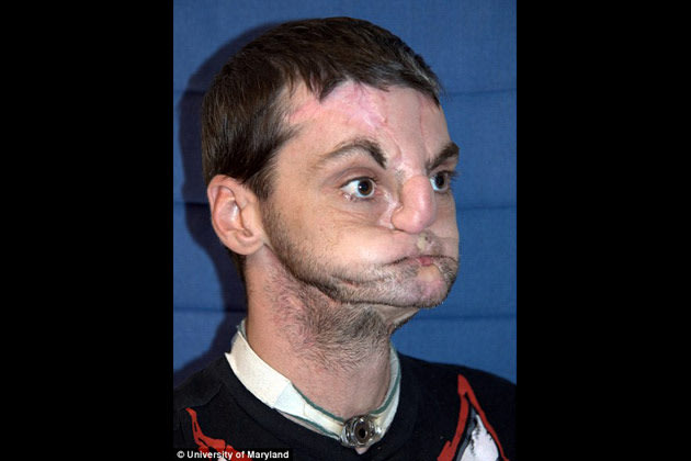زرع وجه بدون فكين وشفتين وأنف وأسنان شاهد الصور  Face-transplant-181012-630-09-jpg_074757