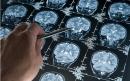 Risk of developing Alzheimer’s rises by almost 50 per cent if people have distant relatives with disease
