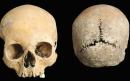 Anglo-Saxon skull found with nose and lips cut off is first physical evidence of brutal punishment for adultery