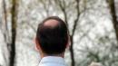 New drug for alopecia shows promise: What you need to know