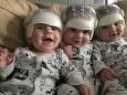 Triplet babies make medical history after all braving procedure for rare skull condition